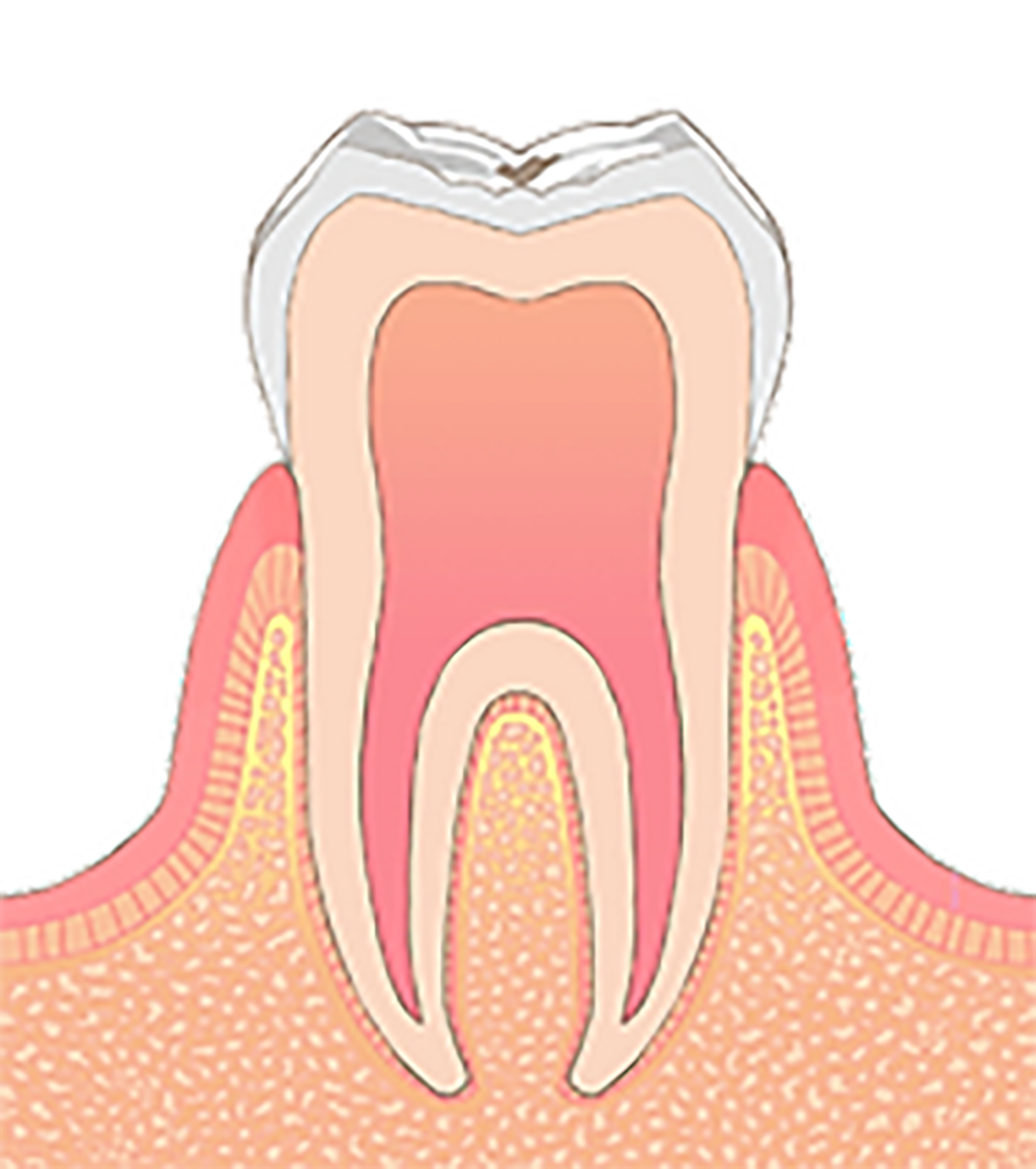 C0 歯の表面がわずかに溶けている状態