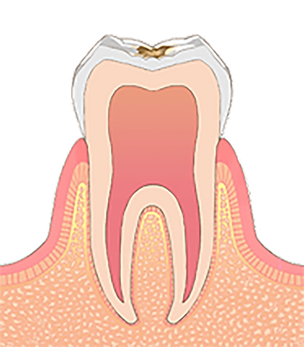 C1 歯のエナメル質内部まで溶けた状態