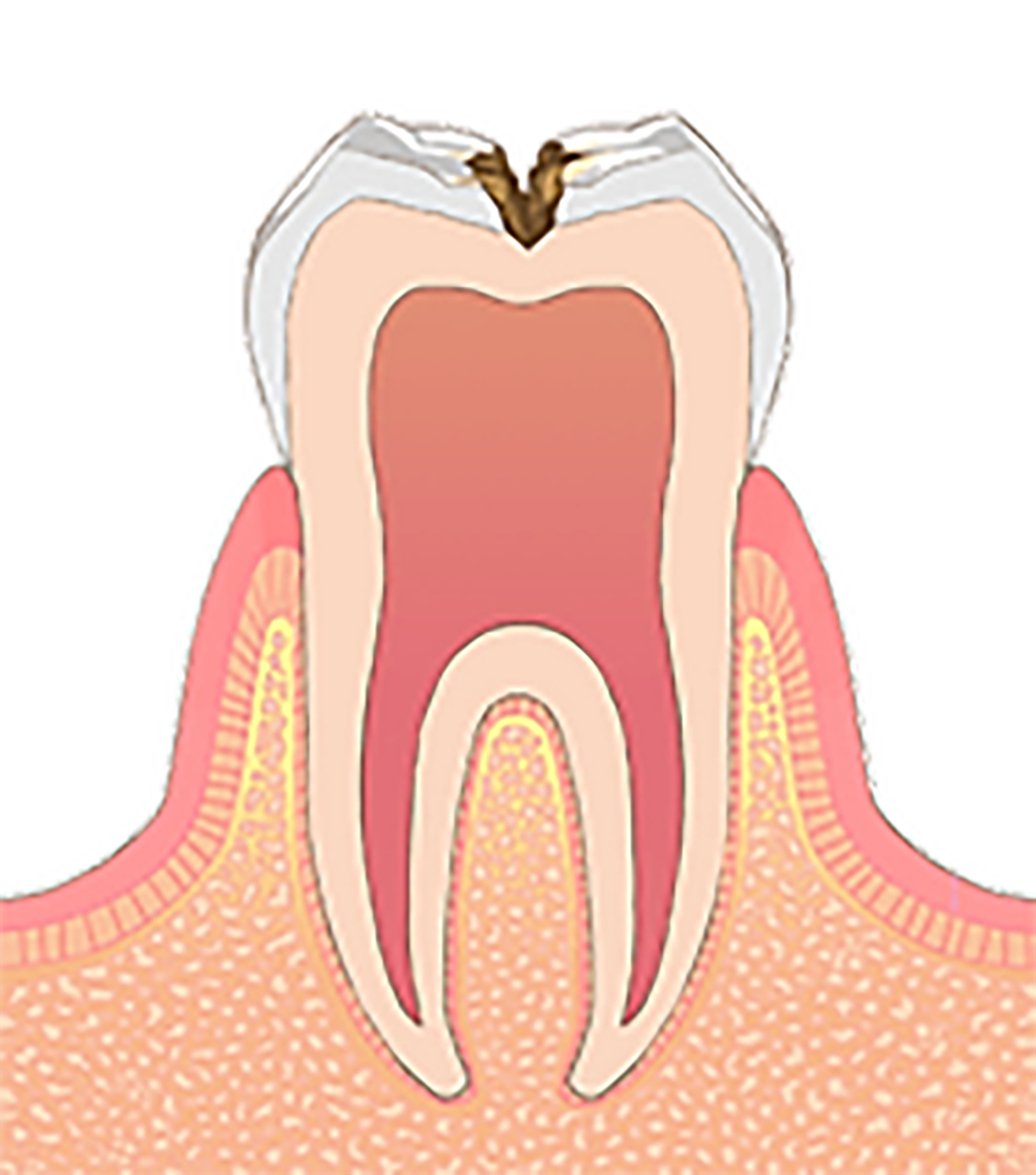 C2 虫歯菌が歯の象牙質まで広がった状態