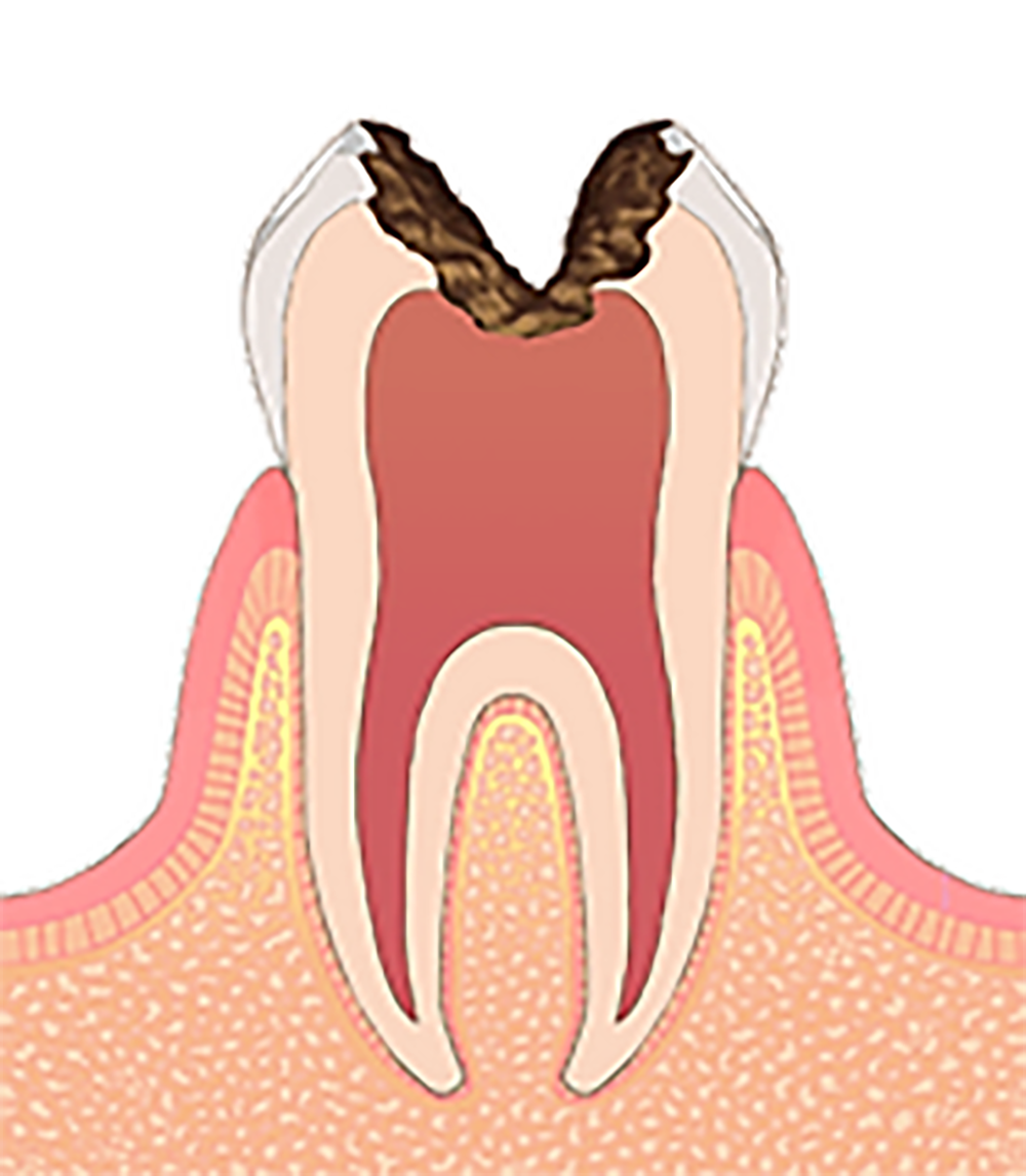 C3 虫歯菌が歯髄まで侵入した状態