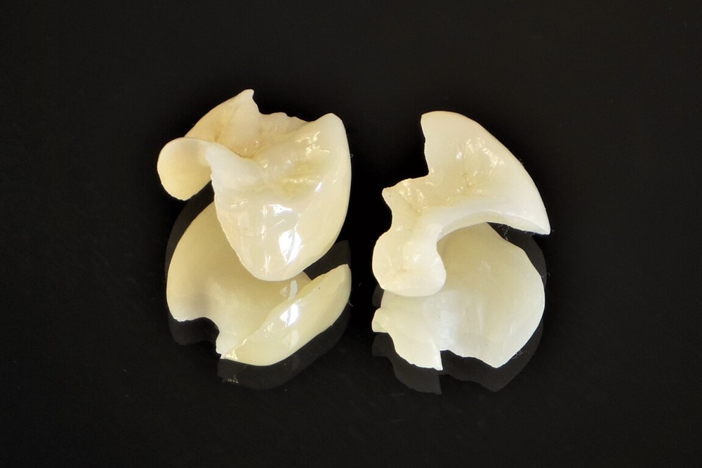 ジルコニアインレー