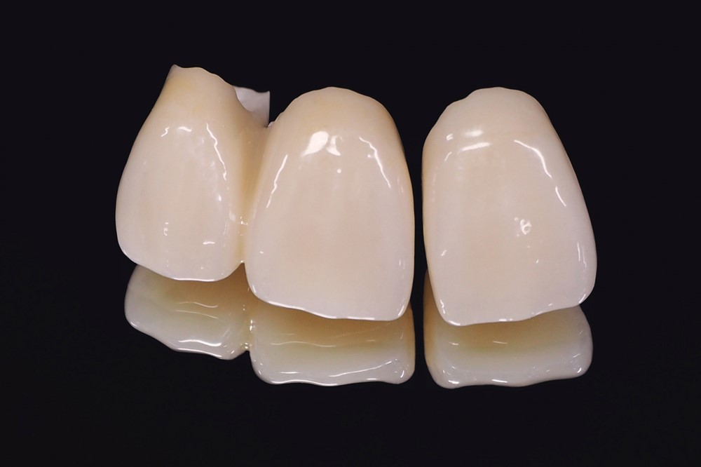 ジルコニアクラウン