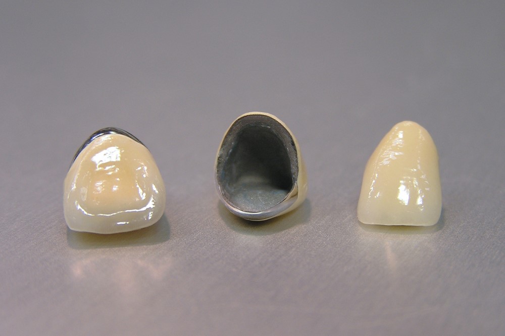 メタルボンドクラウン