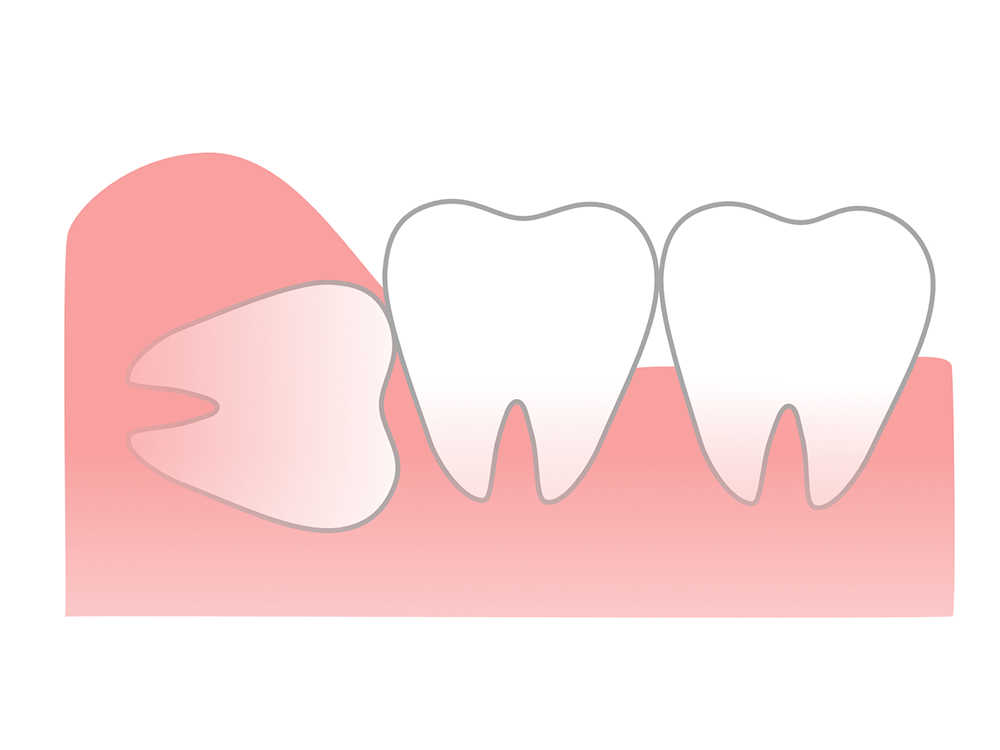親知らずの抜歯に対応