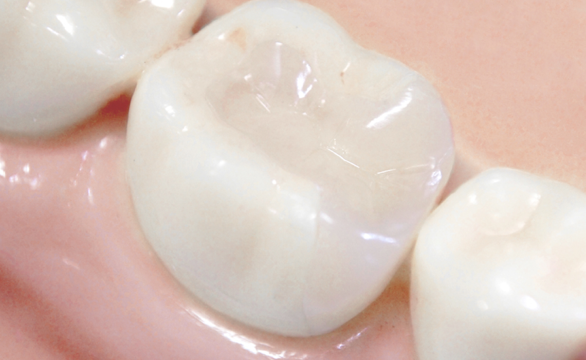 セラミック治療